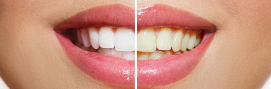 Resultado de imagem para clareamento dental